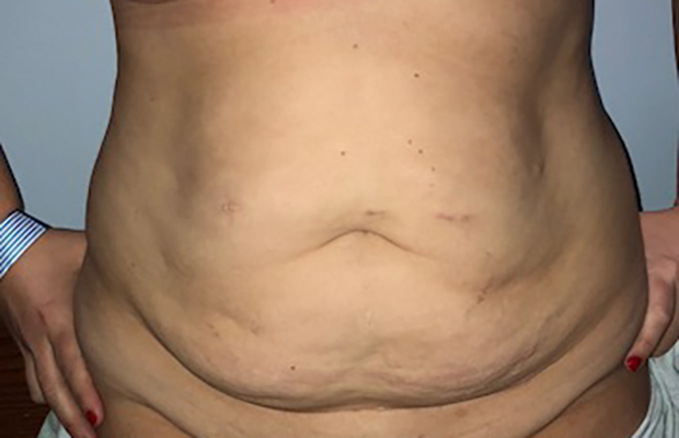 Abdominal Muscle Separation - Tummy Tuck Chicago