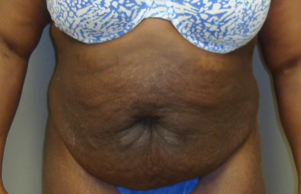 Tummy Tuck (Abdominoplasty) Chicago